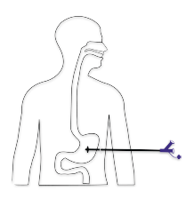 Gastrostomia