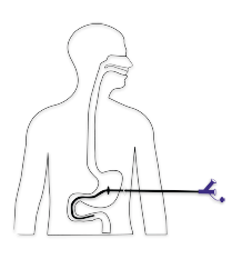 Gastrojejunostomia PEG-PEJ